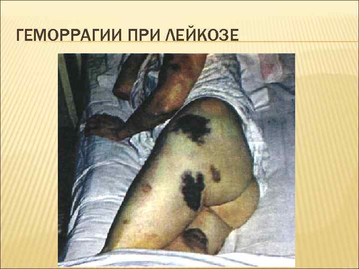 ГЕМОРРАГИИ ПРИ ЛЕЙКОЗЕ 