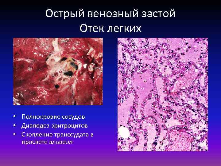 Острый венозный застой Отек легких • Полнокровие сосудов • Диапедез эритроцитов • Скопление транссудата