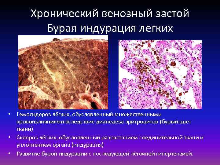 Хронический венозный застой Бурая индурация легких • Гемосидероз лёгких, обусловленный множественными кровоизлияниями вследствие диапедеза