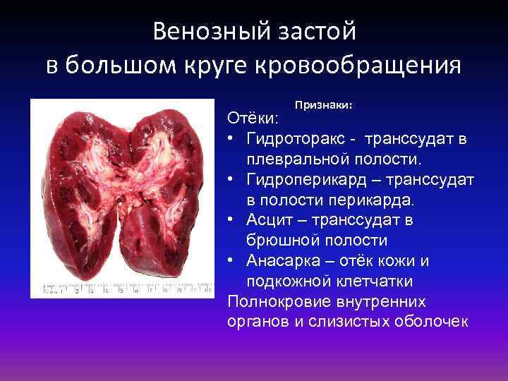 Венозный застой в большом круге кровообращения Признаки: Отёки: • Гидроторакс - транссудат в плевральной
