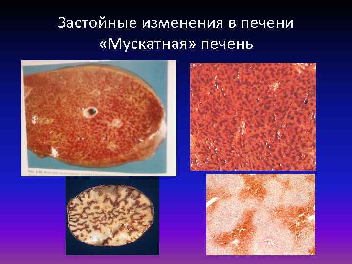 Застойные изменения в печени «Мускатная» печень 