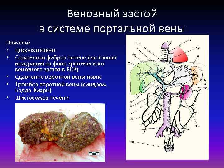 Венозный застой в системе портальной вены Причины: • Цирроз печени • Сердечный фиброз печени