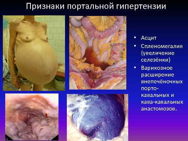 Признаки портальной гипертензии • Асцит • Спленомегалия (увеличение селезёнки) • Варикозное расширение внепечёночных портокавальных