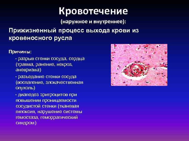 Кровотечение (наружное и внутреннее): Прижизненный процесс выхода крови из кровеносного русла Причины: - разрыв
