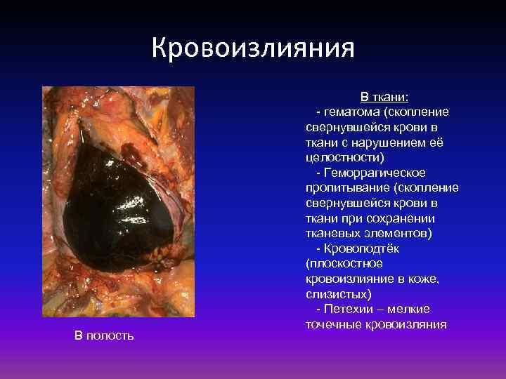 Кровоизлияния В полость В ткани: - гематома (скопление свернувшейся крови в ткани с нарушением