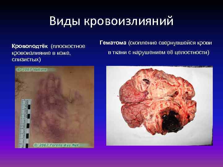 Виды кровоизлияний Кровоподтёк (плоскостное кровоизлияние в коже, слизистых) Гематома (скопление свернувшейся крови в ткани
