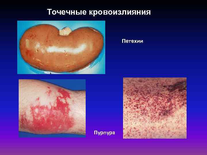 Точечные кровоизлияния Петехии Пурпура 