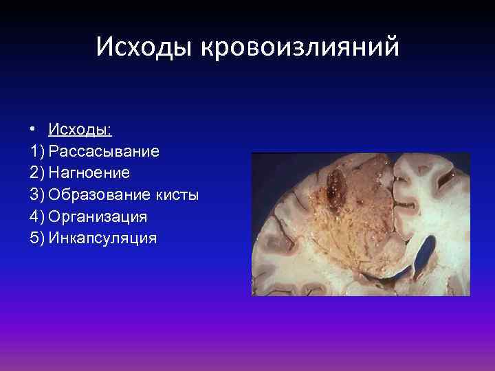 Исходы кровоизлияний • Исходы: 1) Рассасывание 2) Нагноение 3) Образование кисты 4) Организация 5)