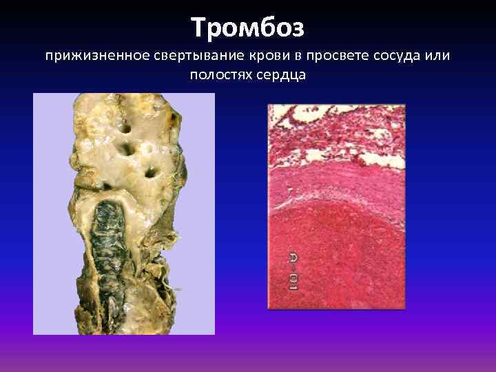 Тромбоз прижизненное свертывание крови в просвете сосуда или полостях сердца 
