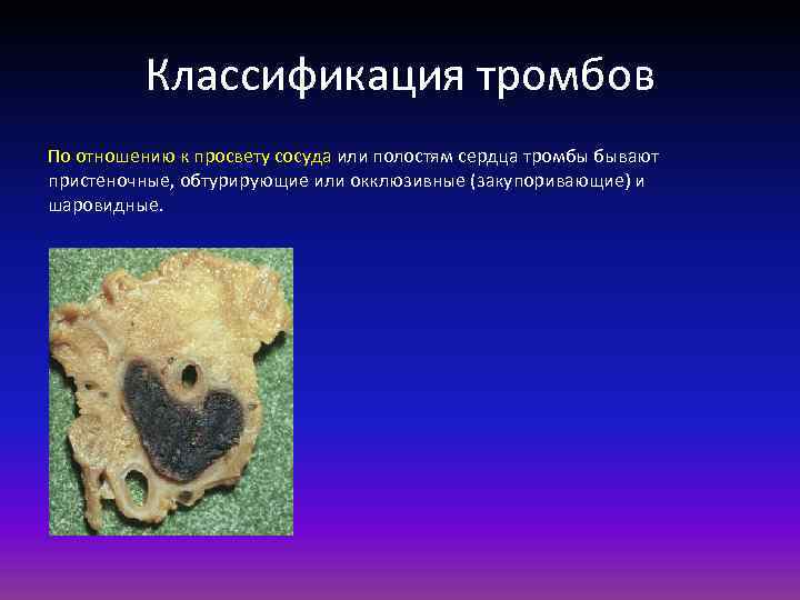 Классификация тромбов По отношению к просвету сосуда или полостям сердца тромбы бывают пристеночные, обтурирующие