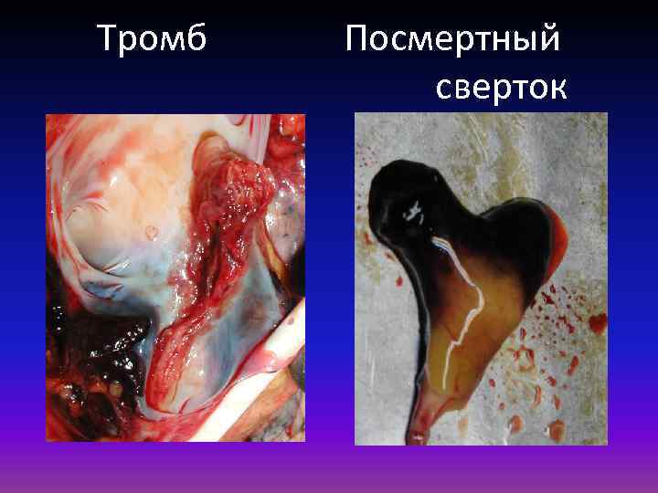 Тромб Посмертный сверток 