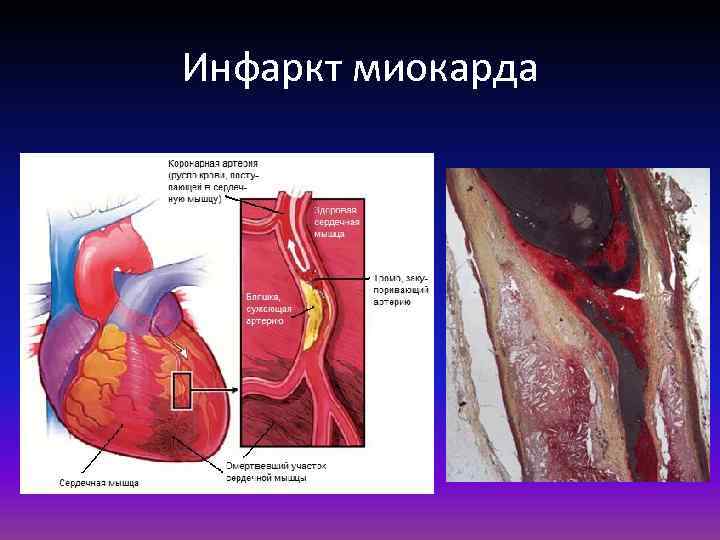 Инфаркт миокарда 