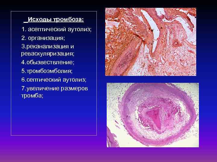  Исходы тромбоза: 1. асептический аутолиз; 2. организация; 3. реканализация и реваскуляризация; 4. обызвествление;