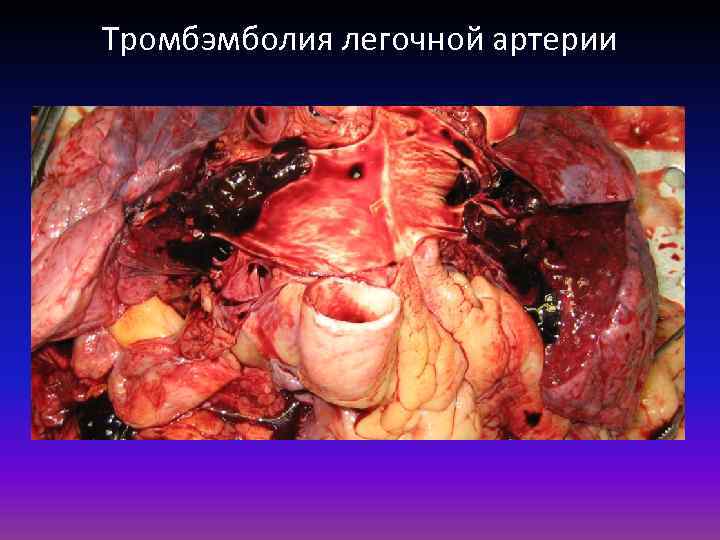 Тромбэмболия легочной артерии 