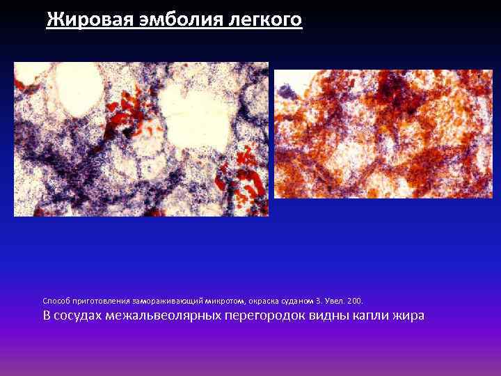 Жировая эмболия легкого Способ приготовления замораживающий микротом, окраска суданом 3. Увел. 200. В сосудах