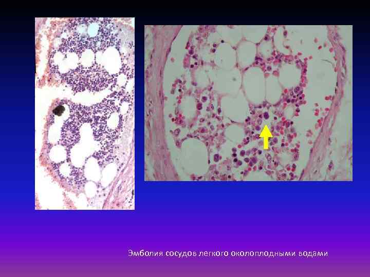 Эмболия сосудов легкого околоплодными водами 
