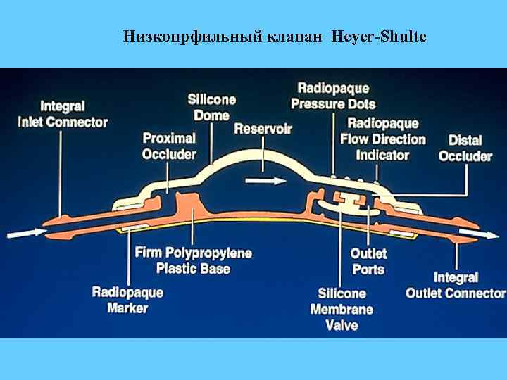 Низкопрфильный клапан Heyer-Shulte 