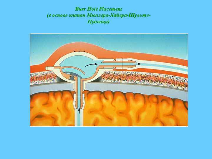 Burr Hole Placement (в основе клапан Мюллера-Хайера-Шульте. Пуденца) 