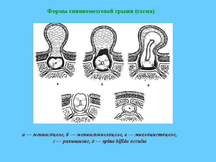 Формы спинномозговой грыжи (схема) а — менингоцеле, б — менингомиелоцеле, в — миелоцистоцеле, г