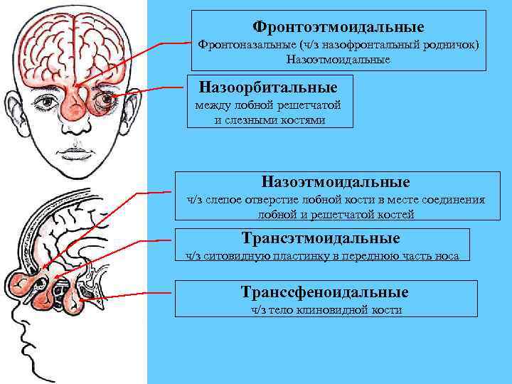 Фронтоэтмоидальные Фронтоназальные (ч/з назофронтальный родничок) Назоэтмоидальные Назоорбитальные между лобной решетчатой и слезными костями Назоэтмоидальные