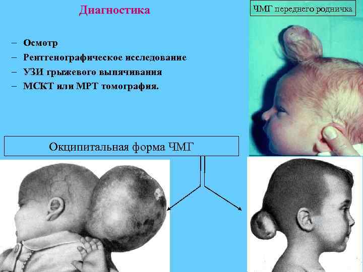 Диагностика – – Осмотр Рентгенографическое исследование УЗИ грыжевого выпячивания МСКТ или МРТ томография. Окципитальная