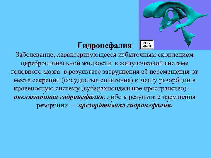 Гидроцефалия Заболевание, характеризующееся избыточным скоплением цереброспинальной жидкости в желудочковой системе головного мозга в результате