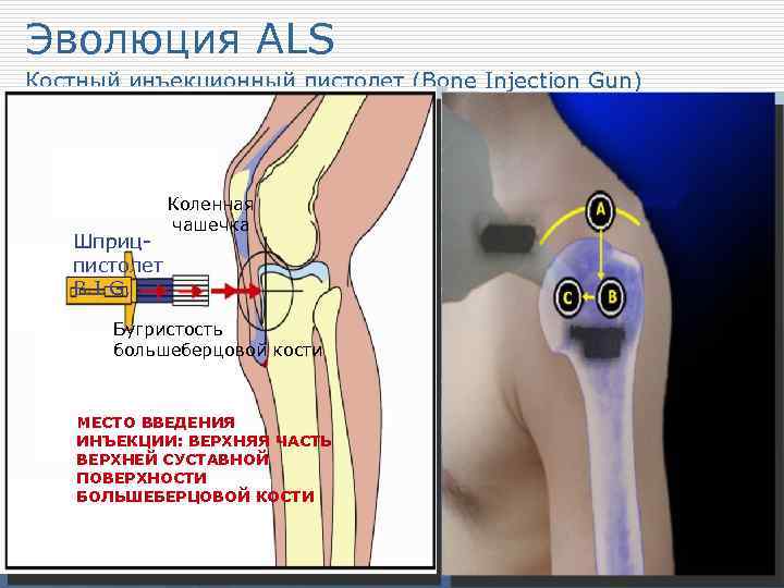 Эволюция ALS Костный инъекционный пистолет (Bone Injection Gun) Коленная чашечка Шприцпистолет B. I. G.