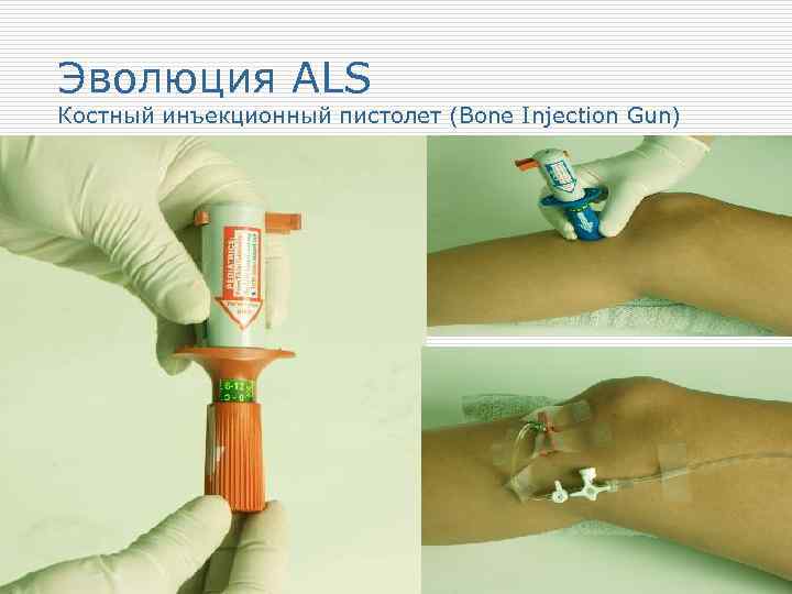 Эволюция ALS Костный инъекционный пистолет (Bone Injection Gun) 