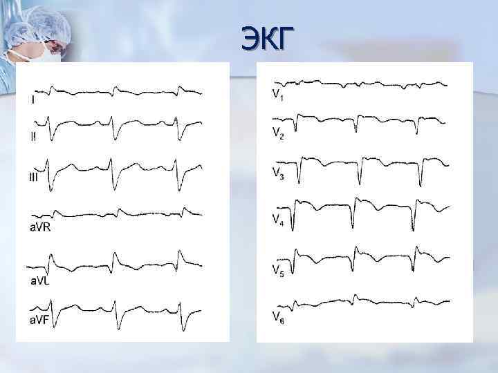 ЭКГ 