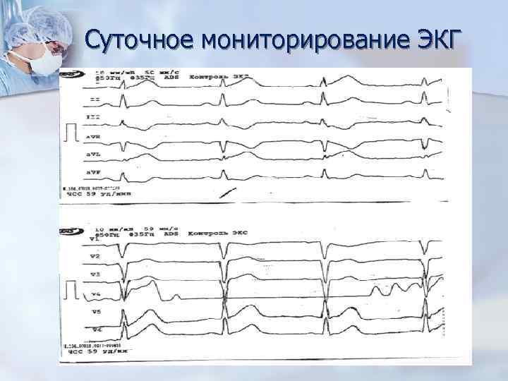 Суточное мониторирование ЭКГ 