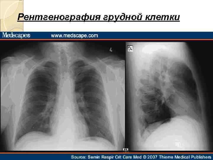Рентгенография грудной клетки 