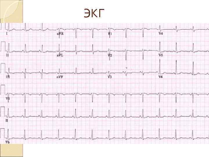 ЭКГ 