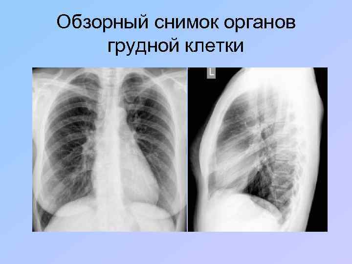 Обзорный снимок органов грудной клетки 