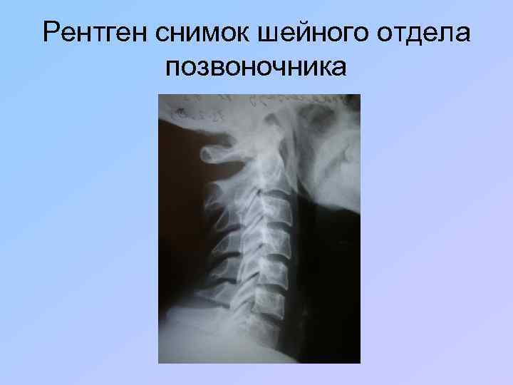 Рентген снимок шейного отдела позвоночника 