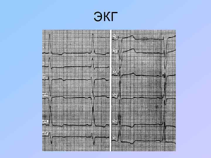 ЭКГ 