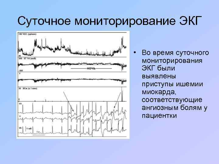 Суточное мониторирование ЭКГ • Во время суточного мониторирования ЭКГ были выявлены приступы ишемии миокарда,