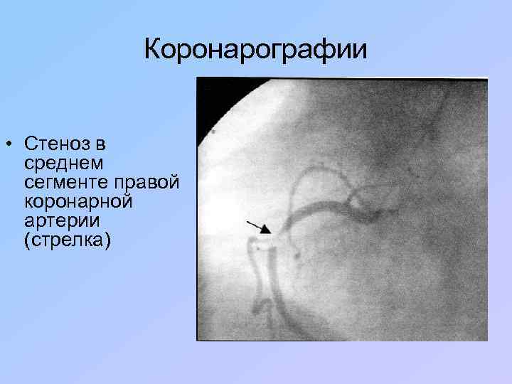 Коронарографии • Стеноз в среднем сегменте правой коронарной артерии (стрелка) 