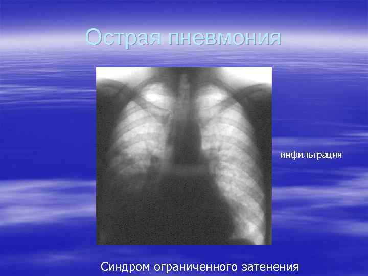 Острая пневмония инфильтрация Синдром ограниченного затенения 