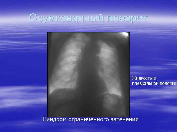 Осумкованный плеврит Жидкость в плевральной полости Синдром ограниченного затенения 