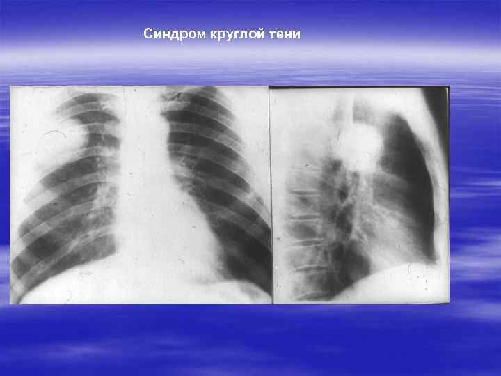 Синдром круглой тени 