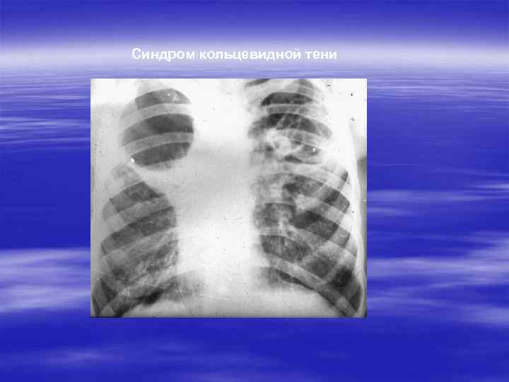 Синдром кольцевидной тени 