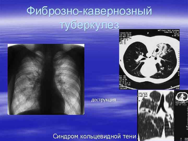Фиброзно-кавернозный туберкулез деструкция Синдром кольцевидной тени 