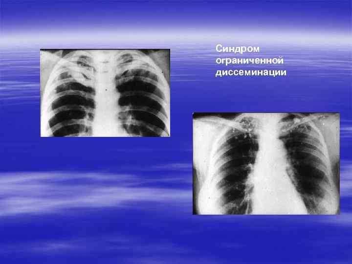 Синдром ограниченной диссеминации 