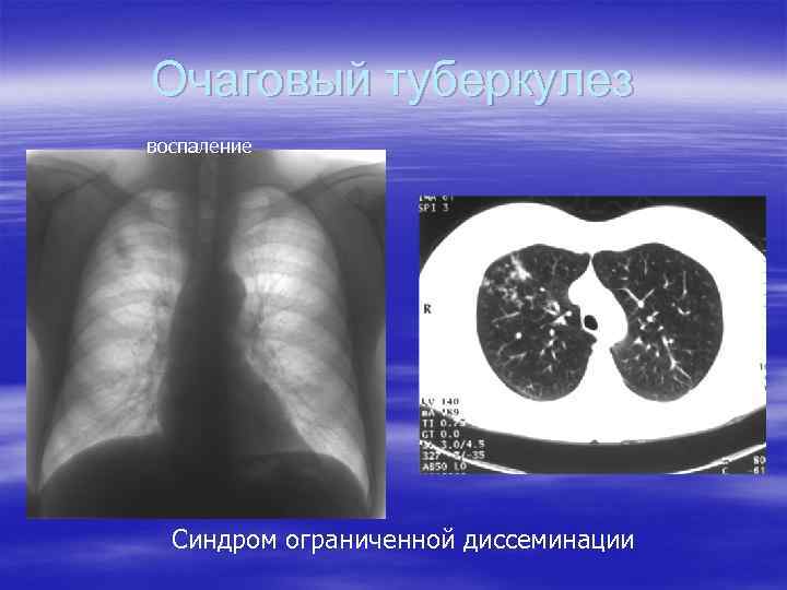 Очаговый туберкулез воспаление Синдром ограниченной диссеминации 