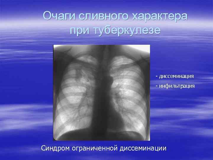 Очаги сливного характера при туберкулезе - диссеминация - инфильтрация Синдром ограниченной диссеминации 