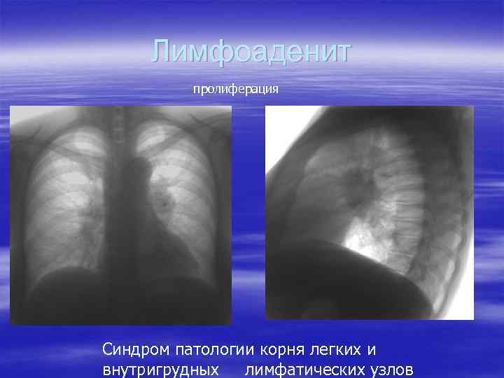 Рентгенологические синдромы легких. Патология корня легкого. Синдром патологии корня лёгкого.