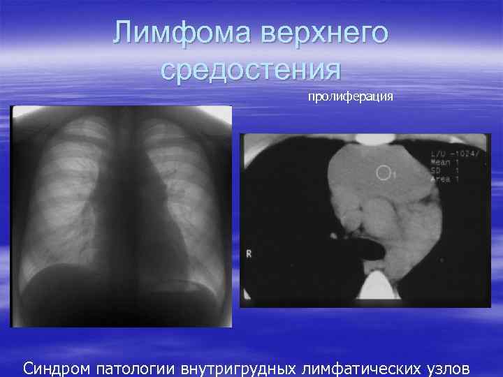 Лимфома верхнего средостения пролиферация Синдром патологии внутригрудных лимфатических узлов 