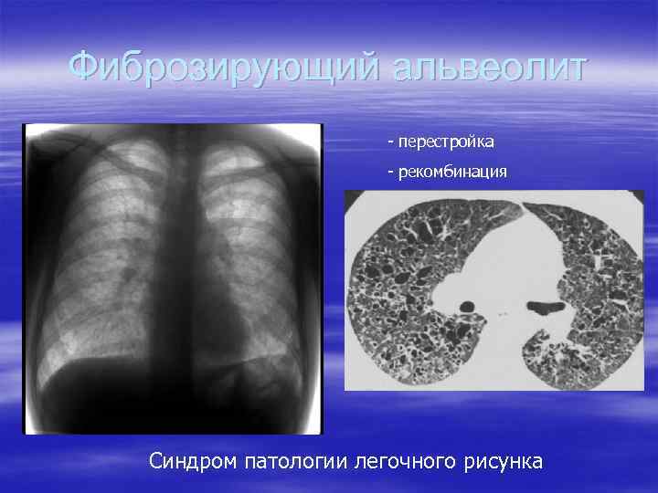 Альвеолиты у детей презентация