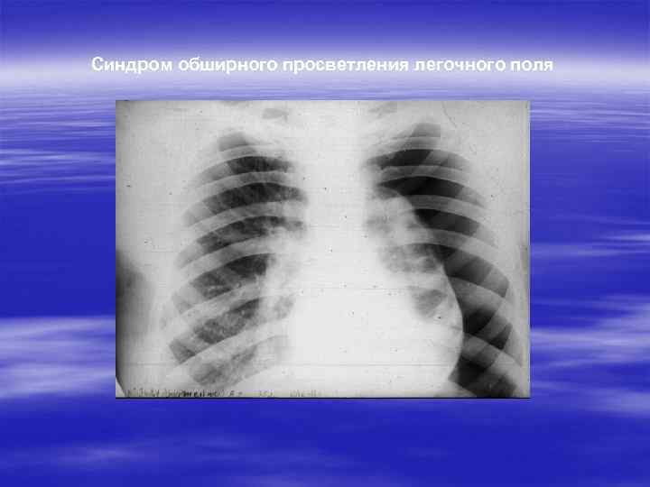 Поля легких. Обширное просветление легочного поля рентген. Синдром обширного просветления легочного поля. Синдром обширного затемнения рентген. Синдром тотального затемнения легочного поля.