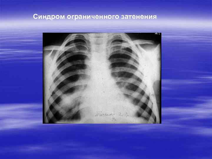 Синдром ограниченного затенения 